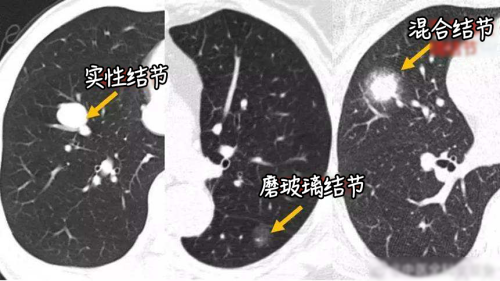 体检发现肺结节，会变成癌吗？