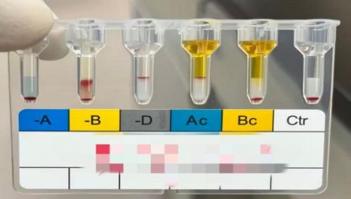 新生儿B抗原减弱原因分析
