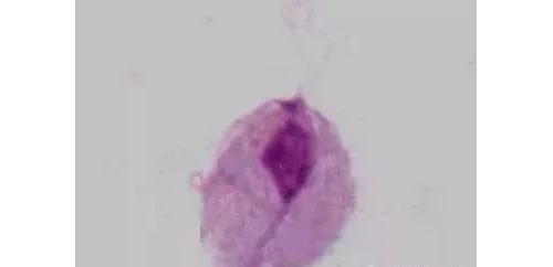 白带常规的「异常结果解读」